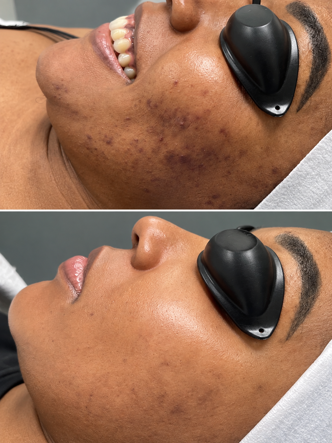 Client before and after acne treatment at Facials by Limary in Stony Point NY